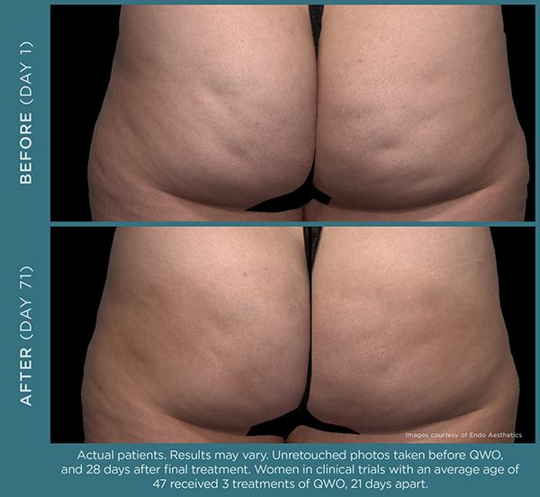 QWO™ cellulite treatment before & after results