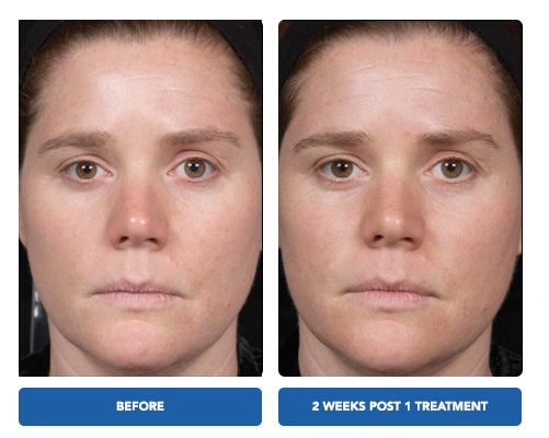 Clear and Brilliant Laser Treatment - Before and After Actual patient result image 1 at Art of Natural Beauty by Khrom Aesthetics, NY