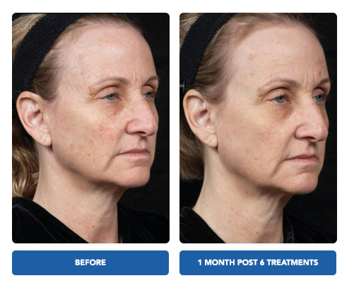 Clear and Brilliant Laser Treatment - Before and After Actual patient result image 3 at Art of Natural Beauty by Khrom Aesthetics, NY