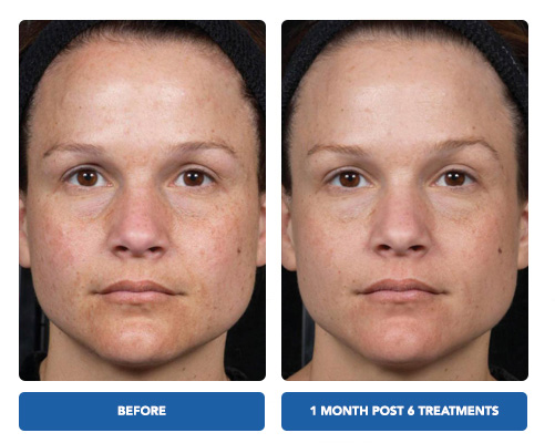 Clear and Brilliant Laser Treatment - Before and After Actual patient result image 4 at Art of Natural Beauty by Khrom Aesthetics, NY