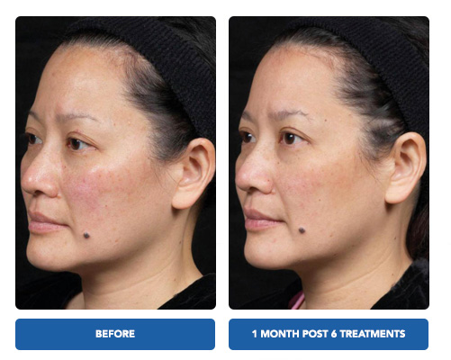 Clear and Brilliant Laser Treatment - Before and After Actual patient result image 5 at Art of Natural Beauty by Khrom Aesthetics, NY